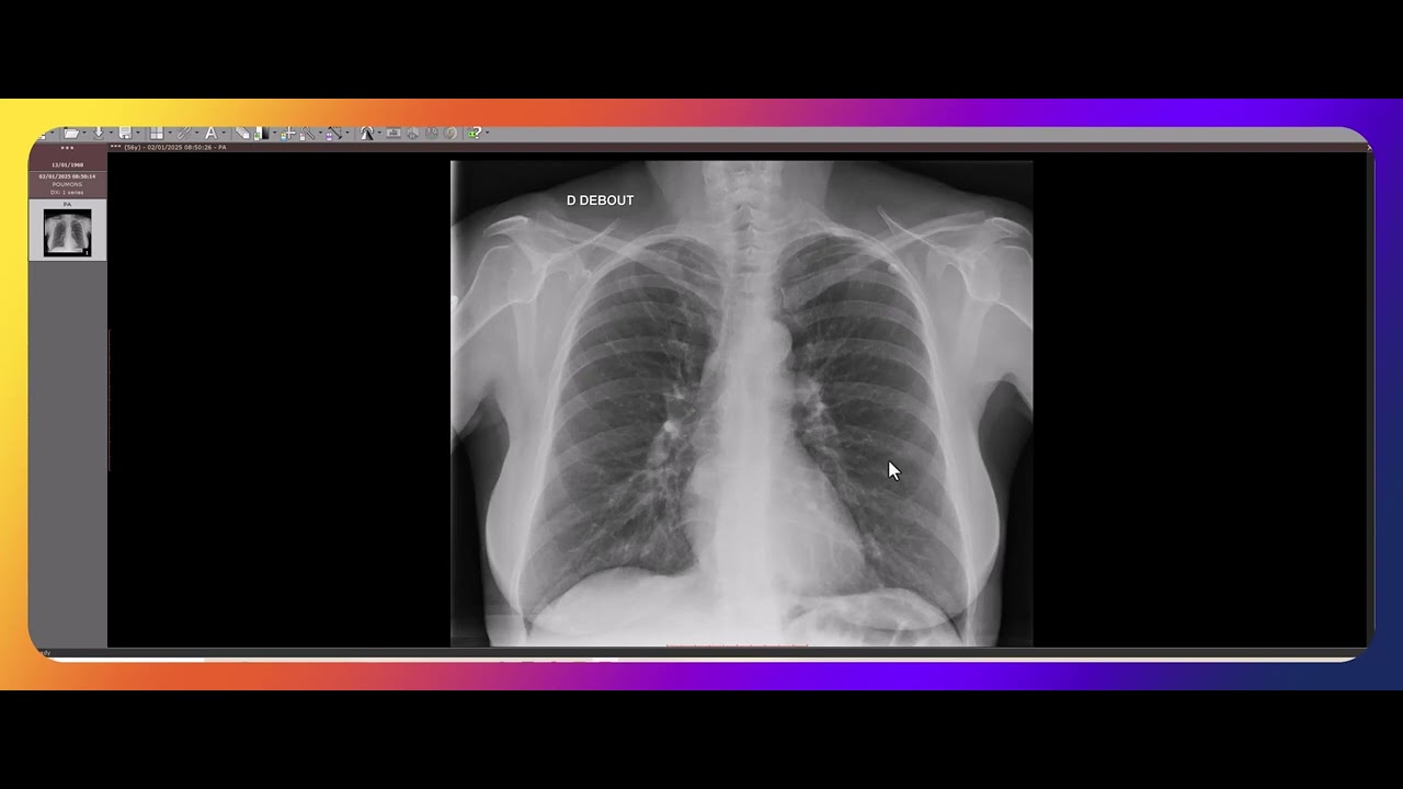 Comment interpréter une radio pulmonaire ?