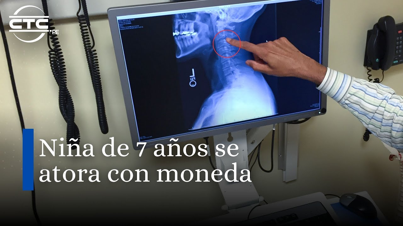 Niña de 7 años se atora con moneda