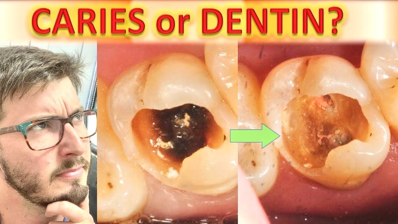 Until Where to Remove Caries on Dentin? (TUTORIAL: Deep Caries Removal. How to: Radiology Detection)