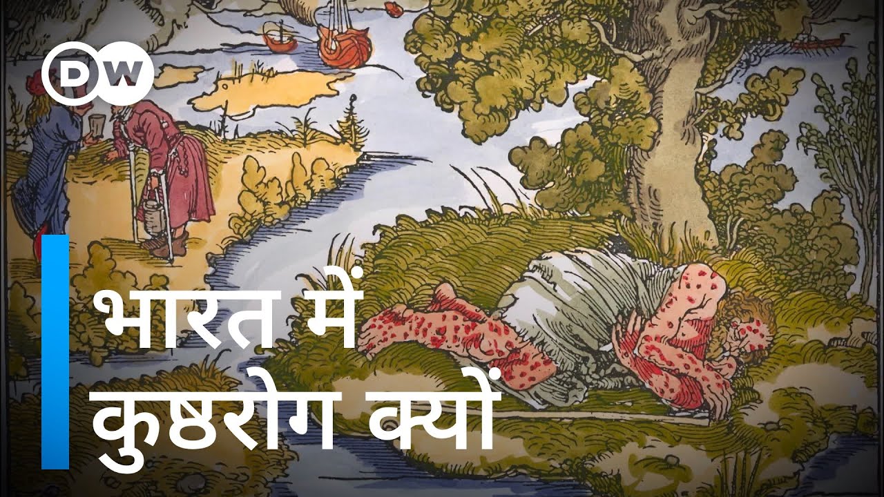 कुष्ठरोग को खत्म करने की चुनौती [Wiping out leprosy remains a challenge]