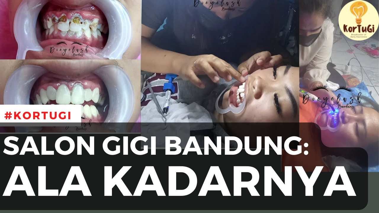 Salon Gigi Bandung: Behel dan Veneer Ala Kadarnya | KorTuGi