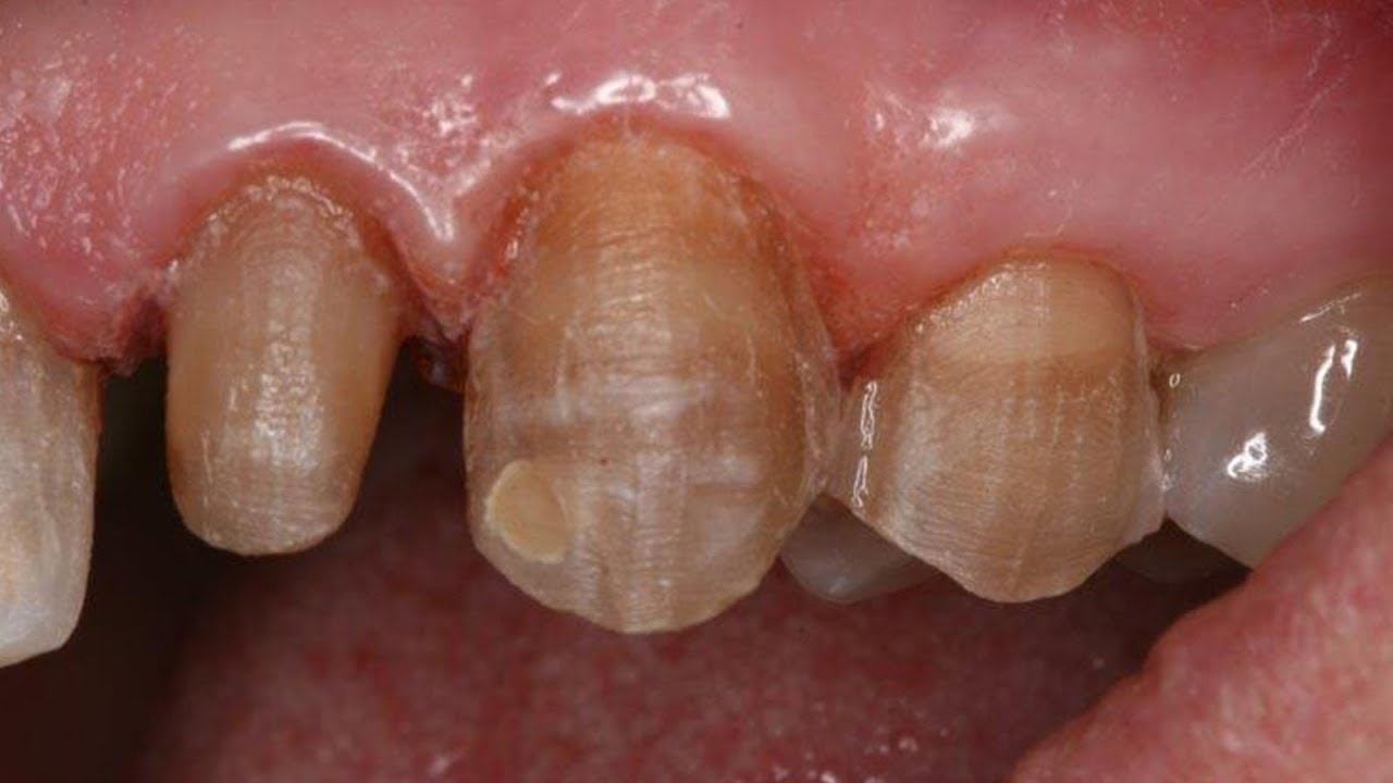 Discolored Teeth Cosmetic Makeover - How to Get The Best Results!