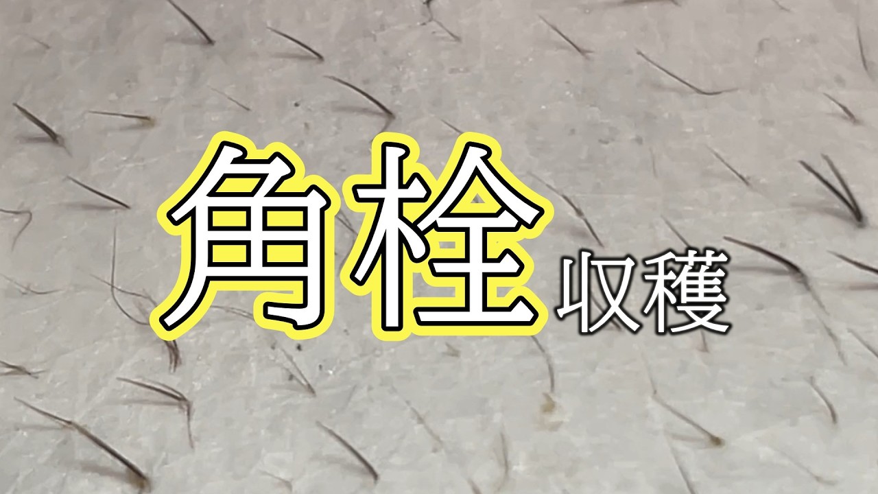 【毛穴パック】背中は角栓と毛束の宝庫