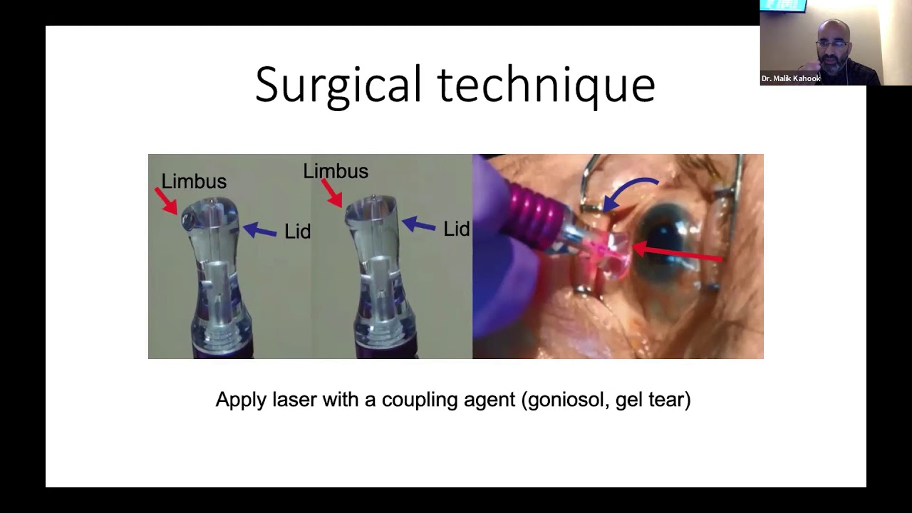 Lecture: Cyclophotocoagulation: Technology and Patient Selection