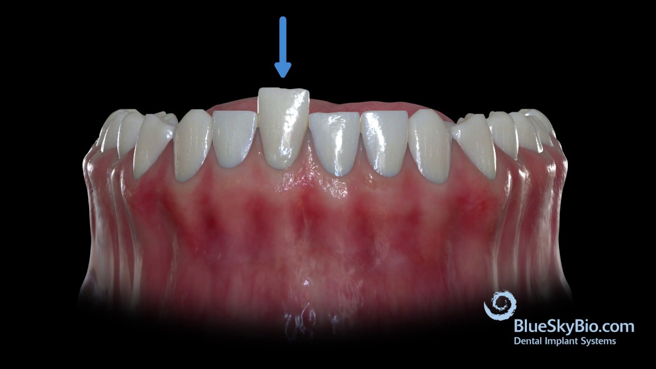 Compensatory Extrusion and Intrusion