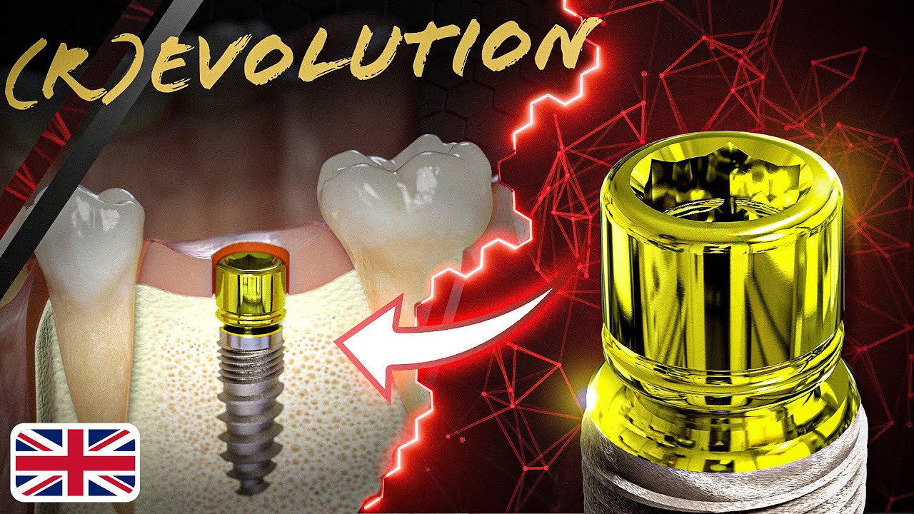 Champions (R)Evolution® Implant: Two-piece system for prosthetic restoration