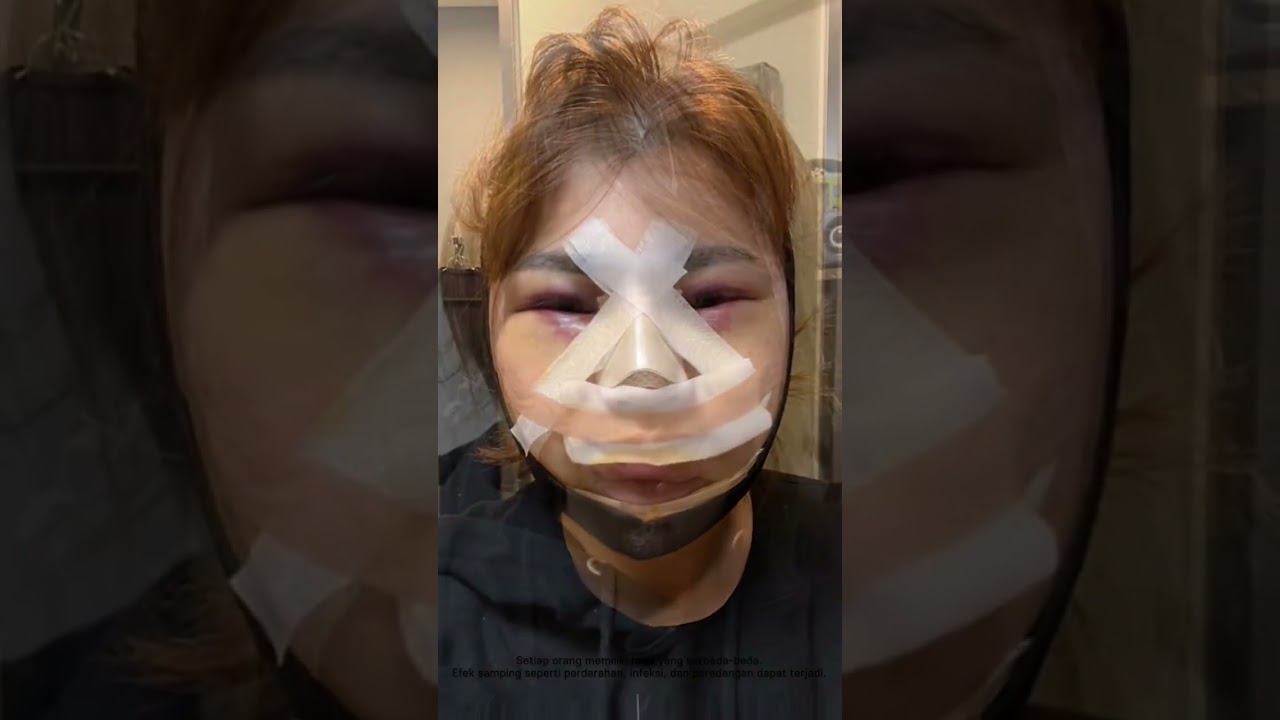 3 jenis kontur+operasi hidung, proses perubahan dari hari operasi sampai dengan satu bulan ❗😲