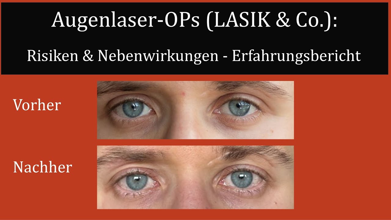 Augenlaser-OPs (LASIK & co.): Risiken & Nebenwirkungen - Erfahrungsbericht