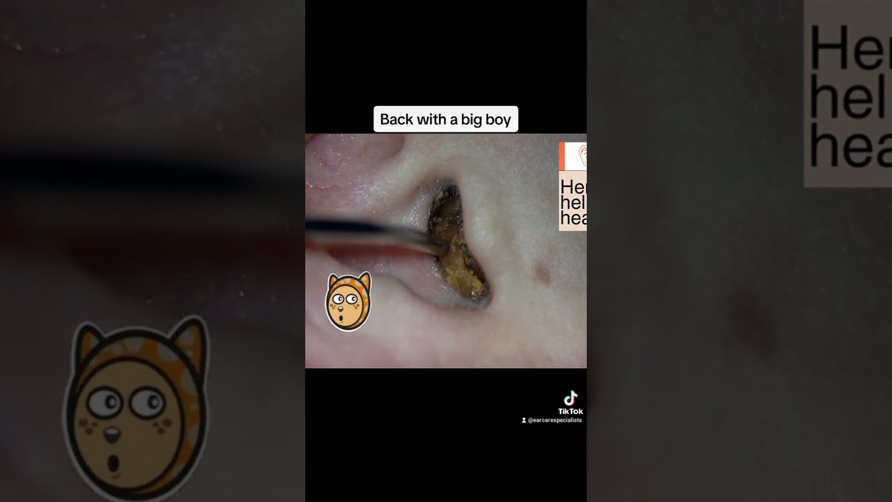 Ear wax extractions from x3 patients #ear #earwax #cerumen #microsuction