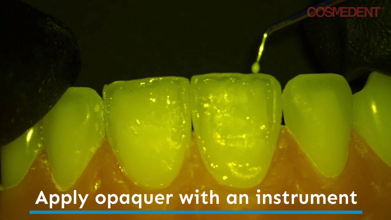 Enhancing the Halo Effect on Composite Restorations with Creative Color Opaquers