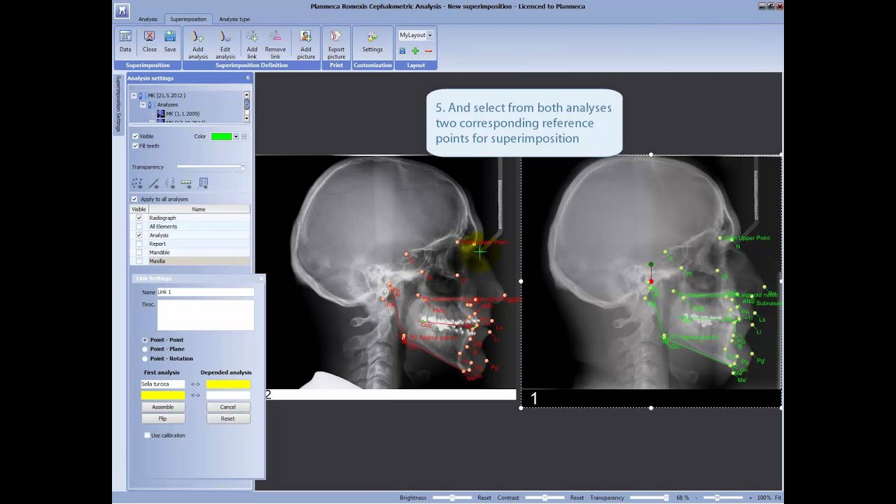 Making superimposition of two analyses in Planmeca Romexis® Cephalometric Analysis module