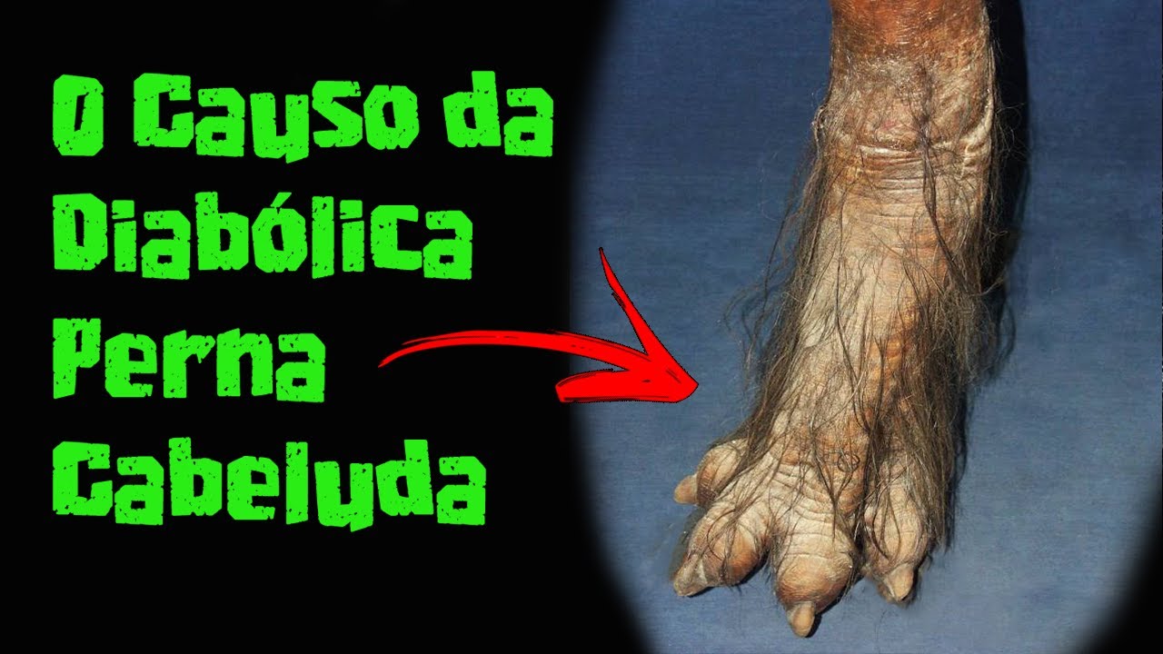 A Endiabrada Perna Cabeluda | Malassombros Urbanos