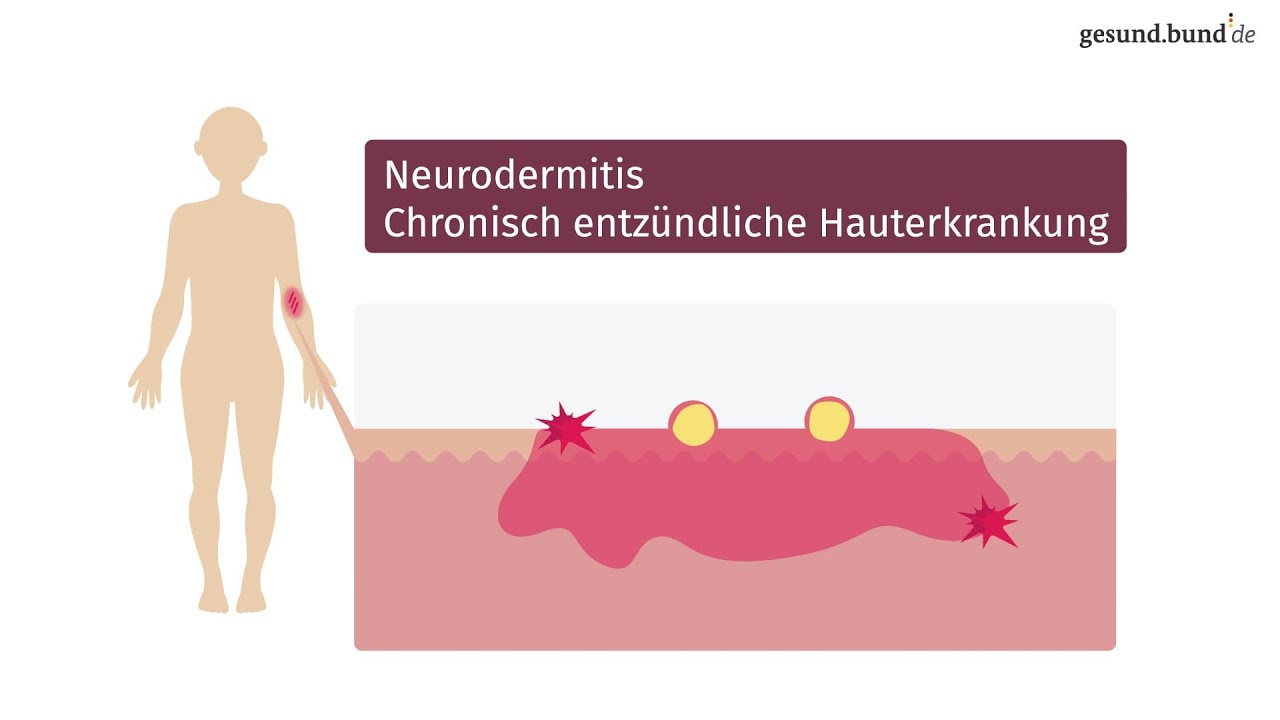 Was ist Neurodermitis und wie kann man sie behandeln?
