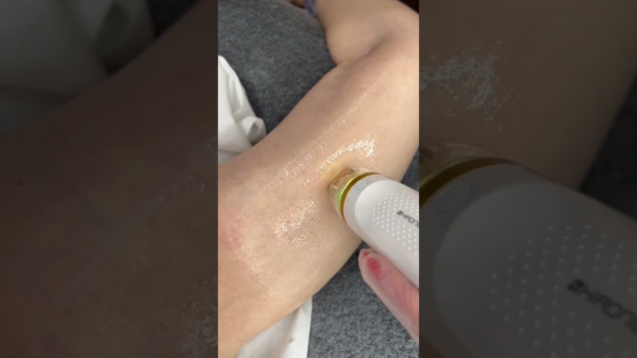 Radiofrequency for skin laxity - Clinicbe #aesthetics #clinicbe #radiofrequency #skinlaxity