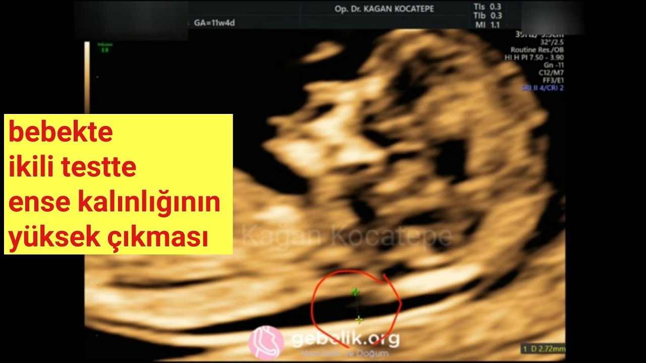 11.5 haftalık bebekte NT (ense kalınlığı) nasıl ölçülür ve yüksek çıkması durumunda ne yapılır?
