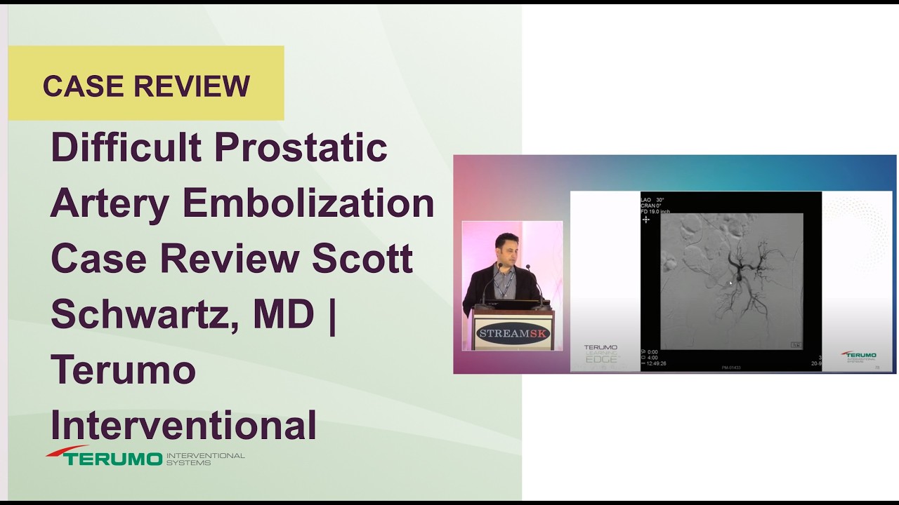 Difficult Prostatic Artery Embolization Case Review Scott Schwartz, MD|Terumo Interventi