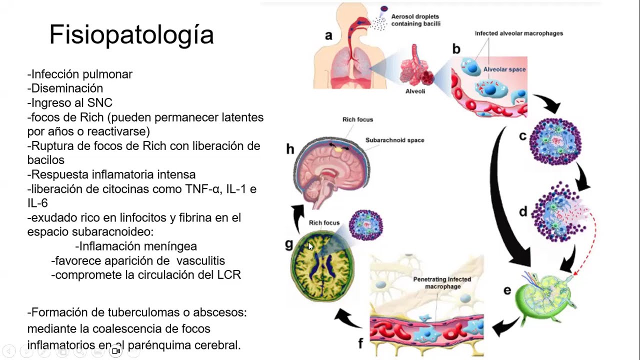 Meningitis tuberculosa Dra  Ximena Justo
