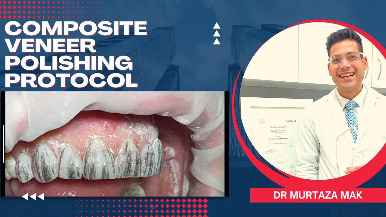 Composite Veneers Polishing Protocol