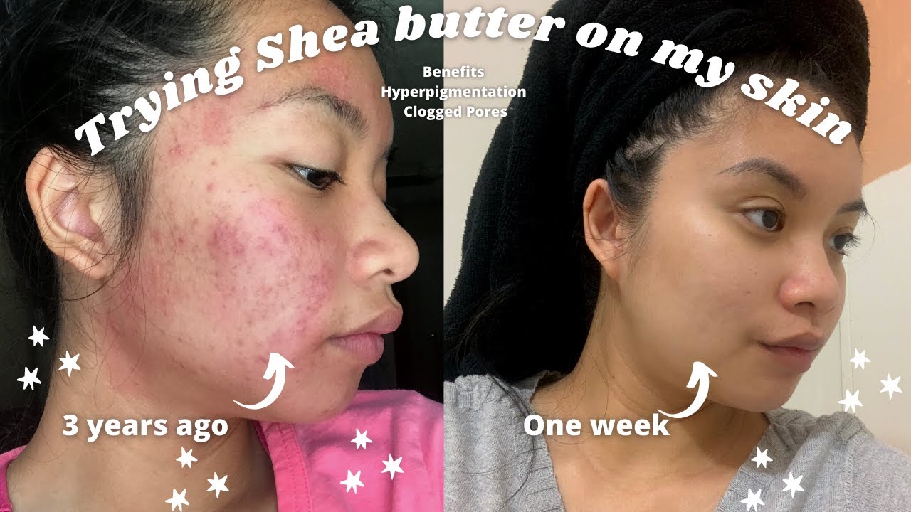How to get glowing skin with Shea butter***clogged pores, acne scars, hyperpigmentation