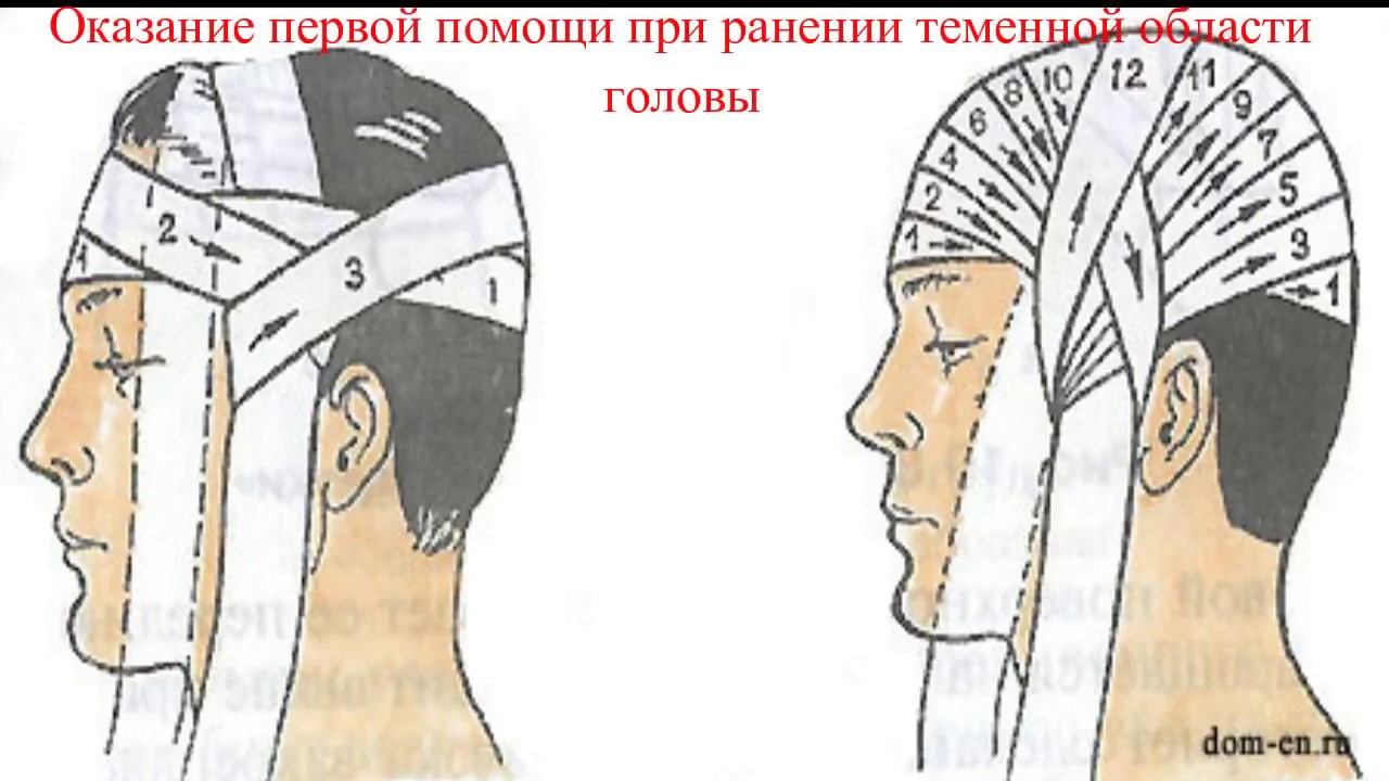 Наложение повязки 