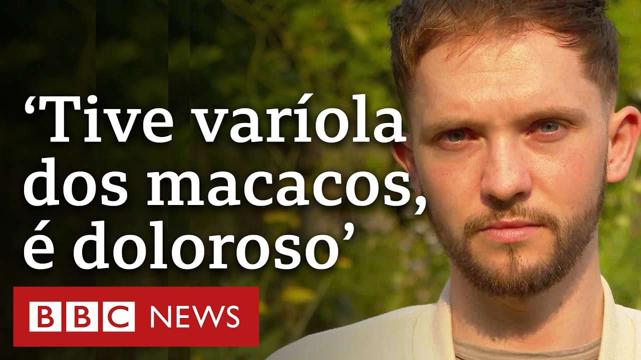 Jovem conta como &eacute; ter var&iacute;ola dos macacos