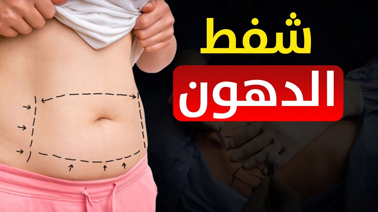 كل ما تحتاج معرفته عن عملية شفط الدهون