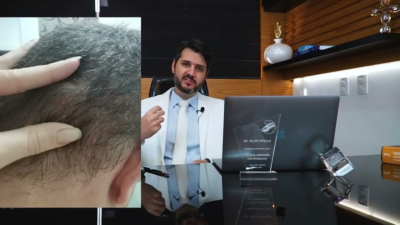 English version - TRANSPLANTE FUE 15 DIAS A 10 MESES (ORIENTAÇÕES E DÚVIDAS)