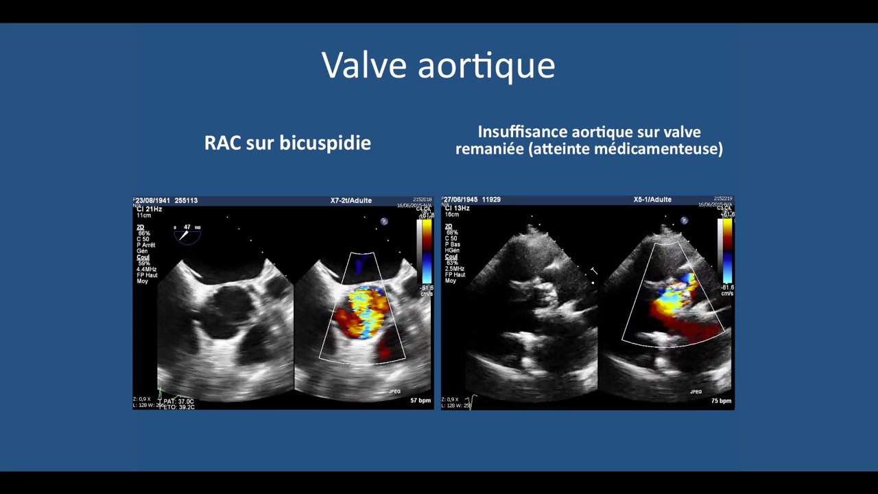 Echographie cardiaque transthoracique: l'essentiel a comprendre pour l'iECN