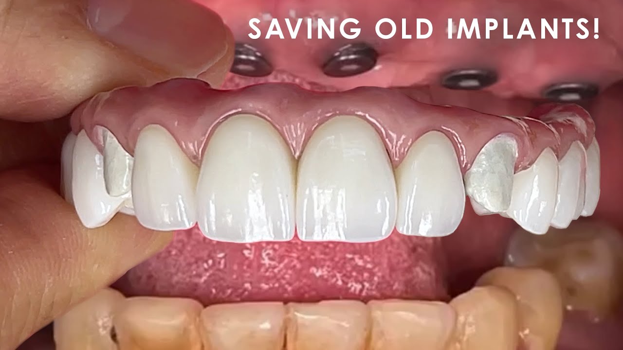 How to Save an Old Implant for a Superior Restoration