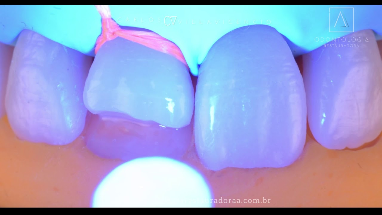 Fractura DENTAL. Un paso a paso de restauración empleando Resina compuesta