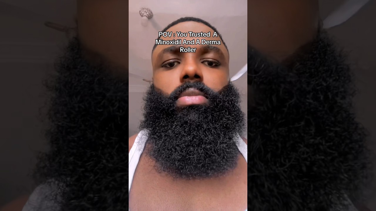 Massive 1year Beard Transformation Using A Minoxidil And Derma Roller. #beard #beardtransformation