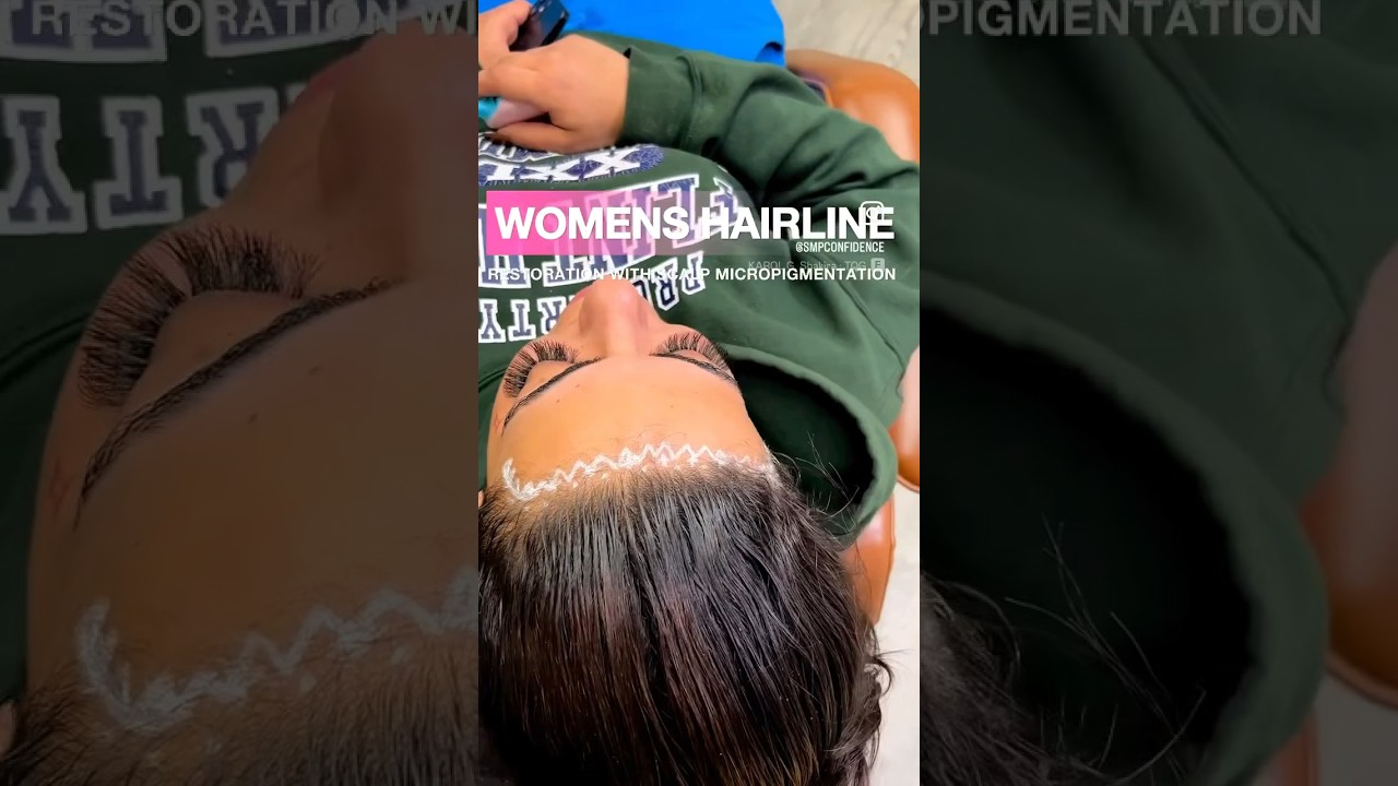 Women gets her hairline restored #smp #scalpmicropigmentation #hairloss #tattoo #women #ink #shorts
