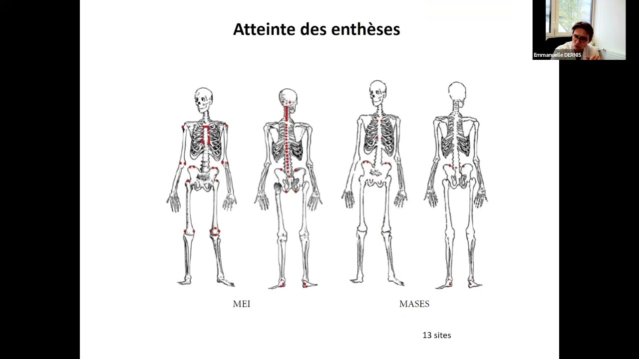 Emmanuelle DERNIS   Le rhumatisme psoriasique