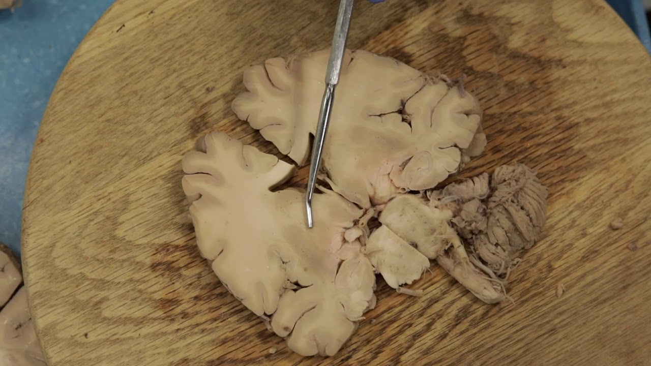 Coronal Brain Dissection