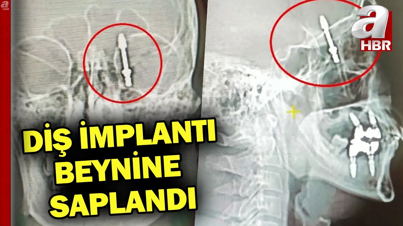 Bursa’da inanılmaz olay: İmplant tedavisinde vida beynine saplandı | A Haber