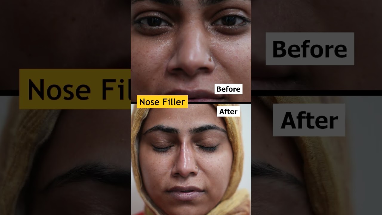 Nose Filler before & After results | Nonsurgical nose job #shorts