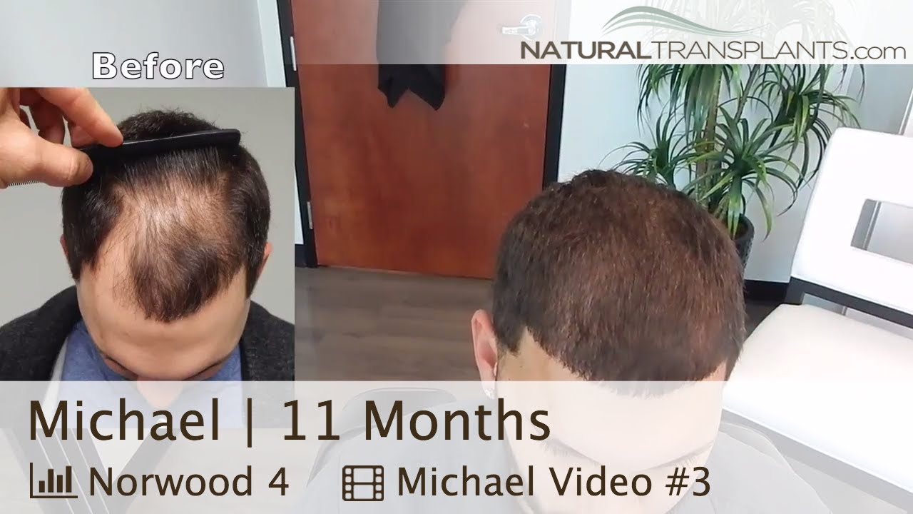 Hair Transplant Washington, D.C. | 11 Month Followup (Michael)