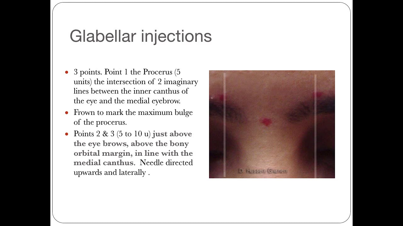 ا.د. حسين غانم يشرح تقنيه حقن البوتكس او الديسبورت