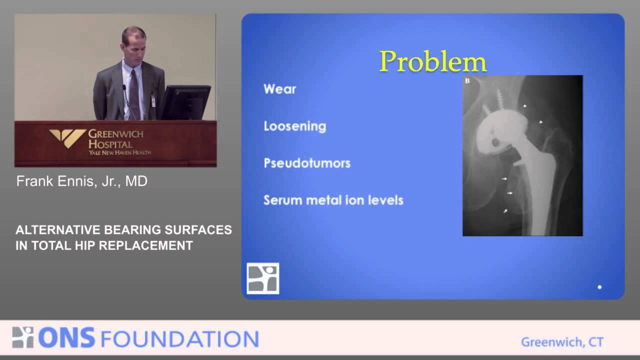 Alternative Bearing Surfaces in Total Hip Replacement