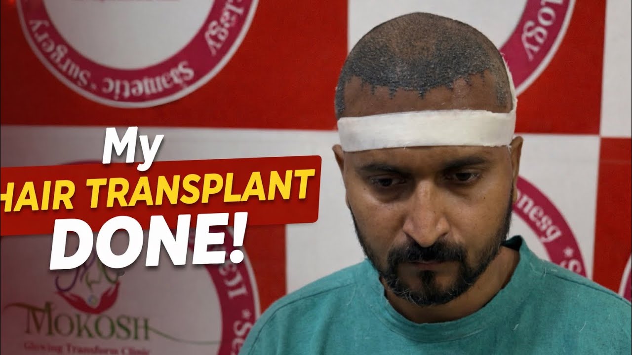 My Hair Transplant Surgery Done || 3500 Graft Used ||