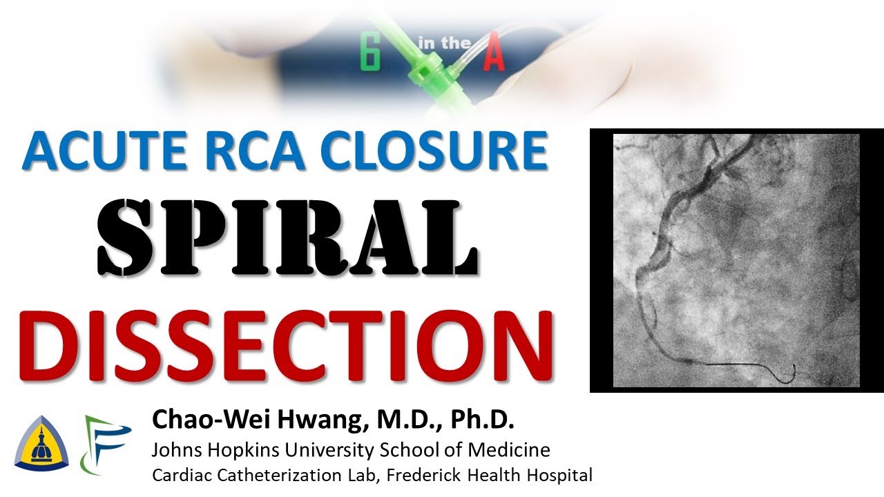 Wire-induced Spiral Dissection of the RCA