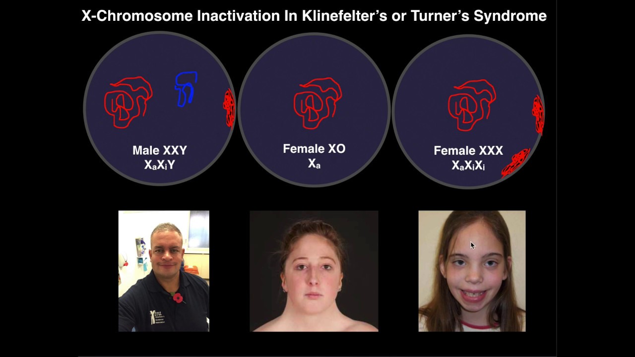 Mechanism of X-Chromosome Aneuploidies [Klinefelter's, Turner's, & XXX]