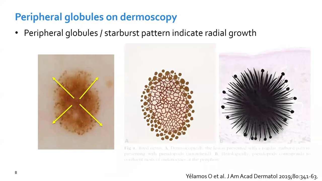 Nevi with peripheral globules  by Oriol Yelamos
