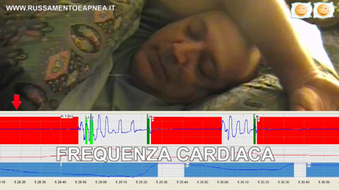L'apnea del sonno in 4 minuti