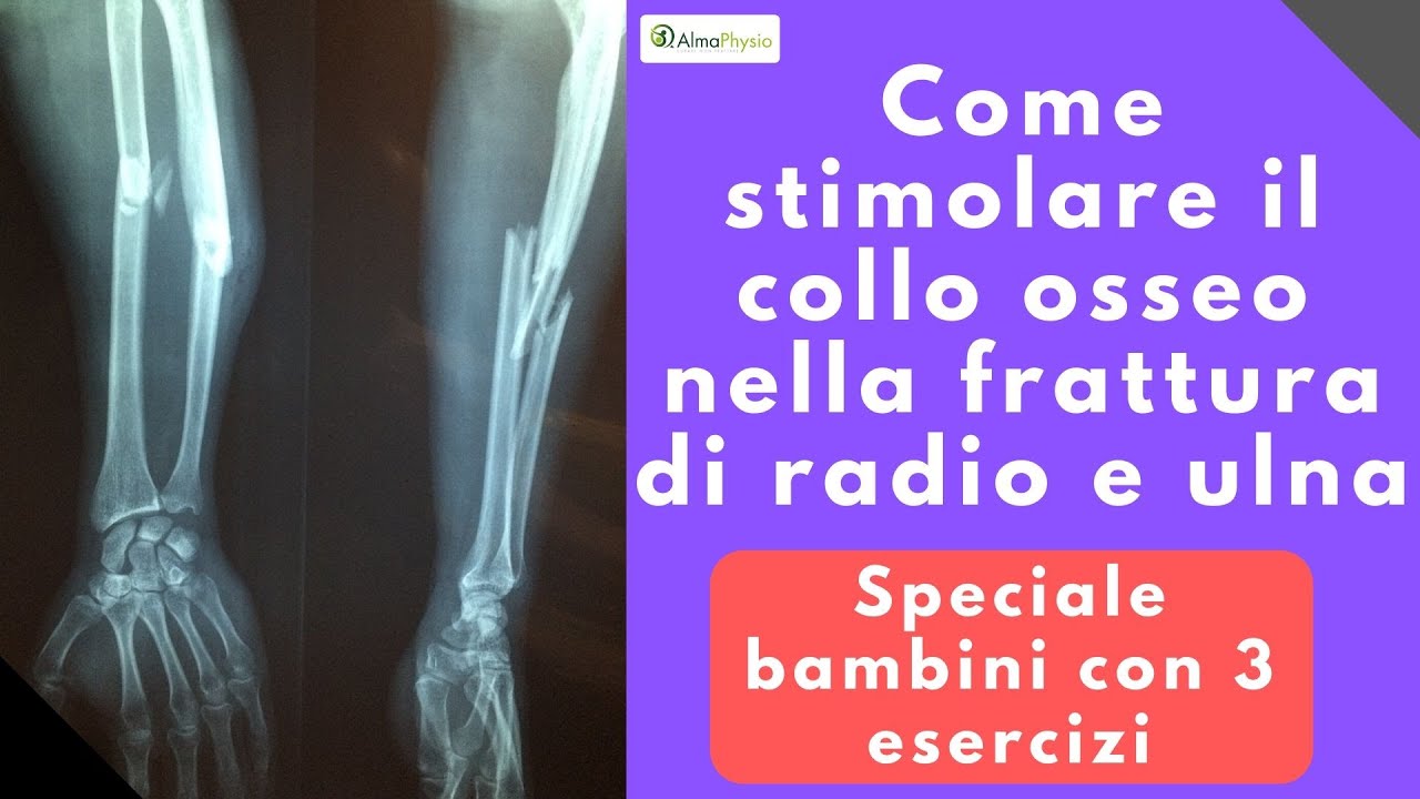Come stimolare il callo osseo nella frattura di radio e ulna (speciale bambini con 3 esercizi!!)