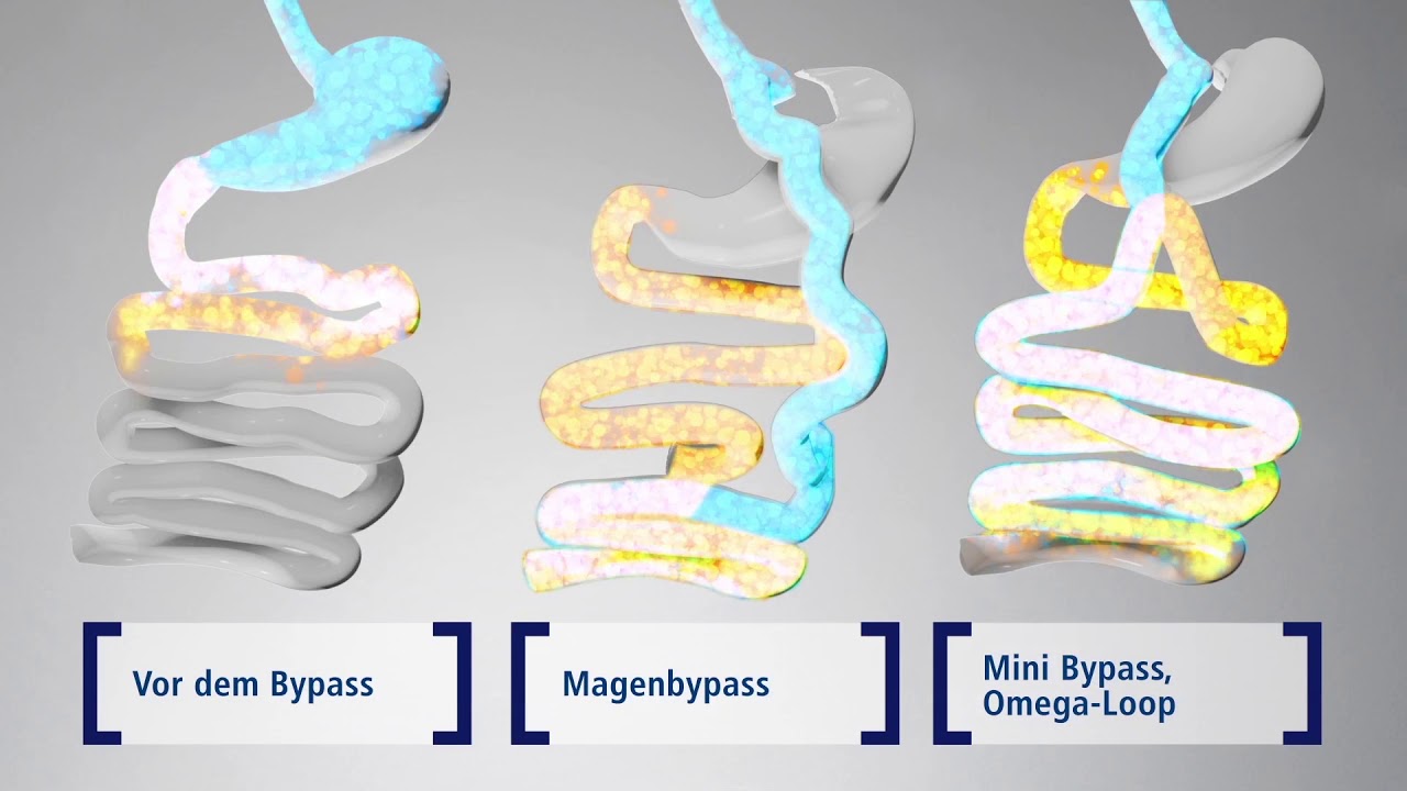 Omega Loop Bypass