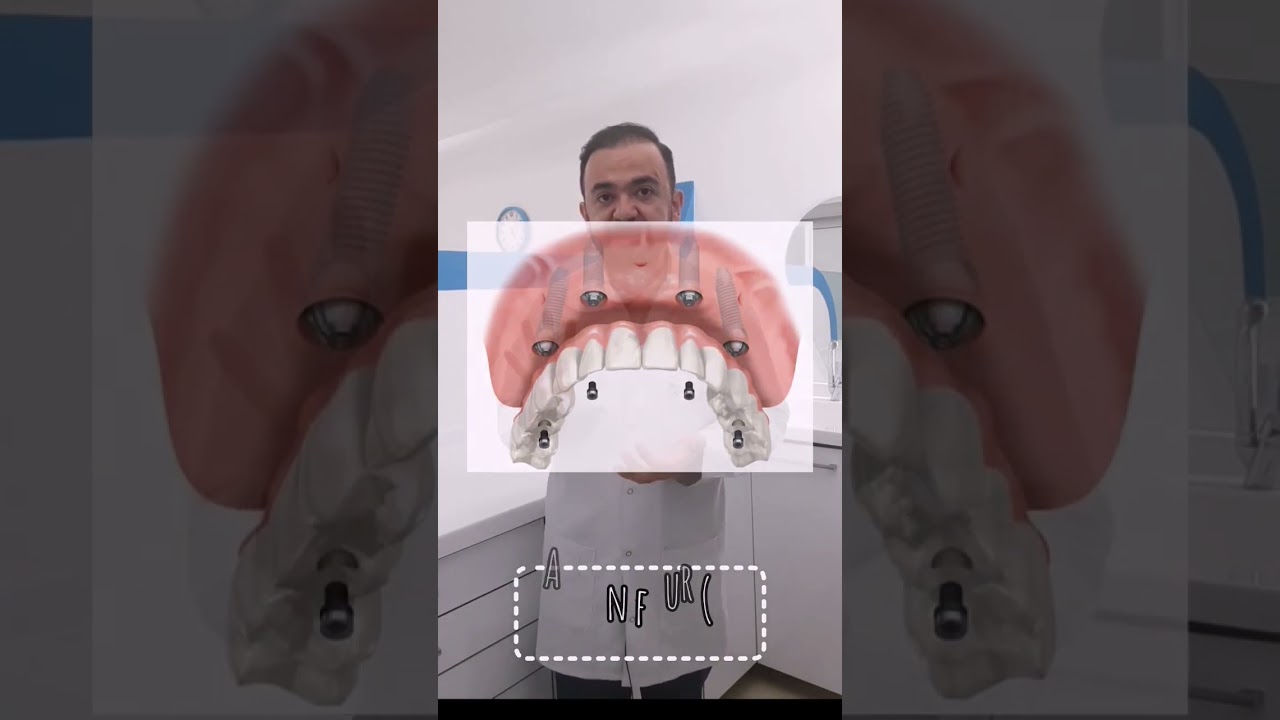 All on four implant tekniği nedir? 4 implant yeterli midir? Ne zaman ve neden yapılır?