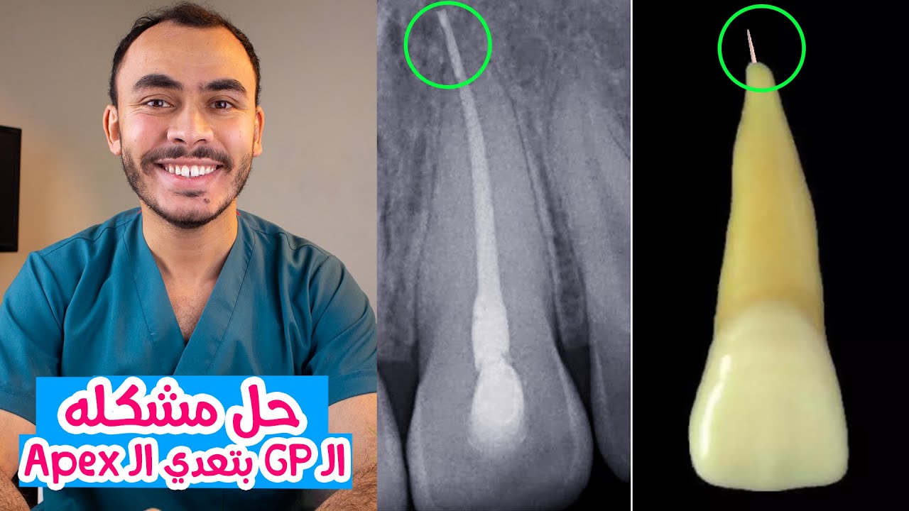 Gutta Percha Extrusion in Endodontic Obturation
