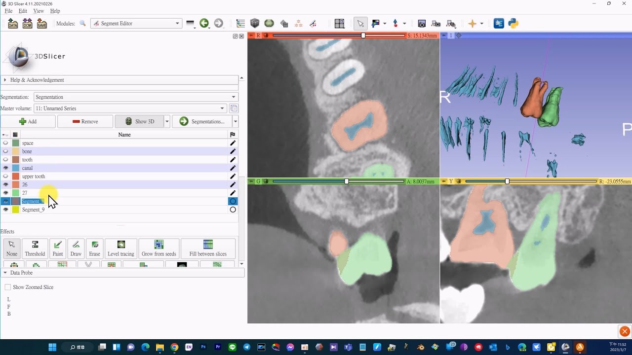 3D slicer 06 - AI auto-segmented label  import into 3D slicer