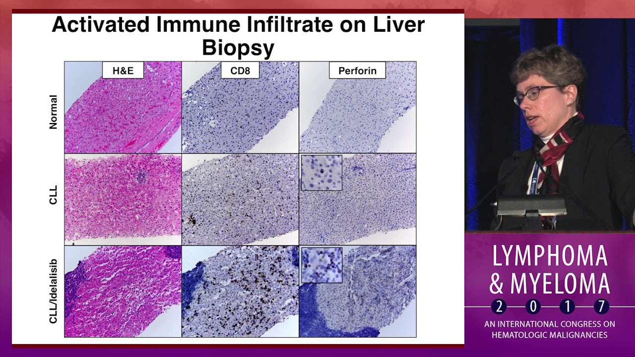 Role of PI3K inhibitors in clinical practice: Uses and pitfalls